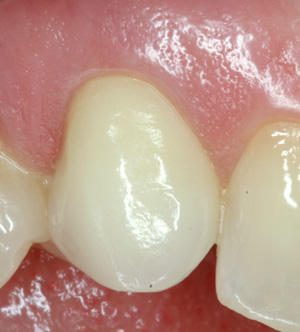 Dental Implant with crown