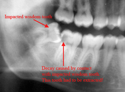 Impacted wisdom teeth causing decay in the adjacent teeth.
