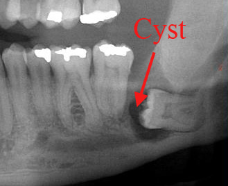 Cysts can form around impacted wisdom teeth